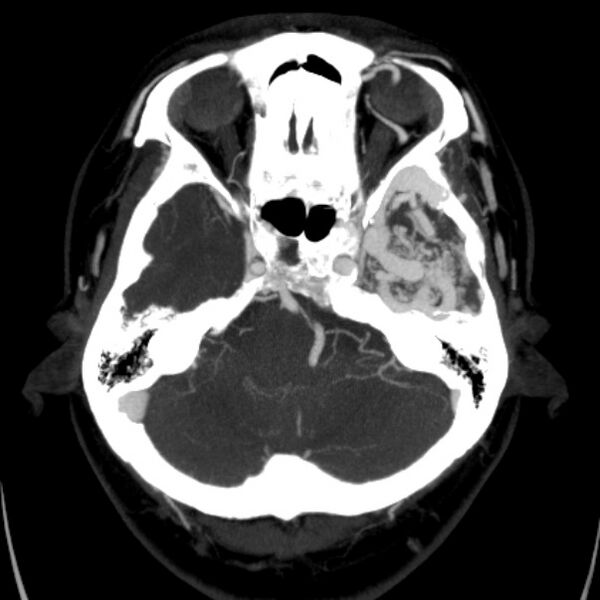 File:Cerebral arteriovenous malformation (Radiopaedia 43729-47189 B 12).jpg