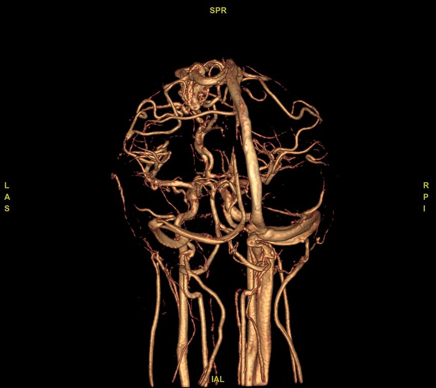 Cerebral arteriovenous malformation (Radiopaedia 61964-70029 VRT 13).jpg