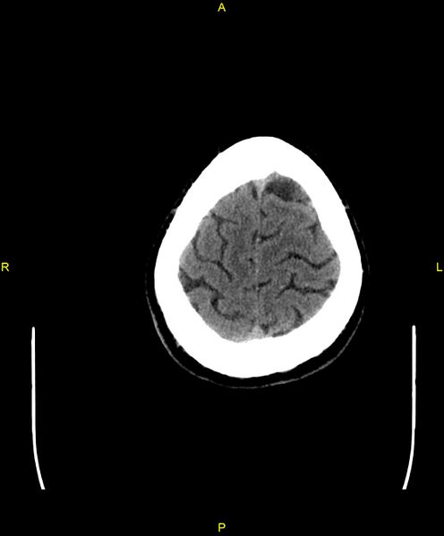 File:Cerebral autosomal dominant arteriopathy with subcortical infarcts and leukoencephalopathy (CADASIL) (Radiopaedia 86108-102051 Axial non-contrast 101).jpg