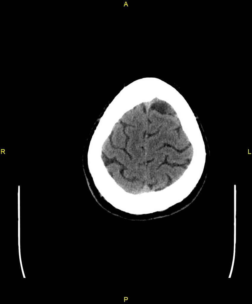 Cerebral autosomal dominant arteriopathy with subcortical infarcts and leukoencephalopathy (CADASIL) (Radiopaedia 86108-102051 Axial non-contrast 101).jpg