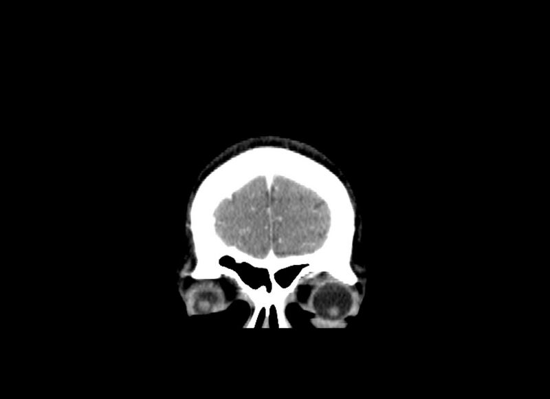 File:Cerebral edema (Radiopaedia 82519-96661 C 56).jpg