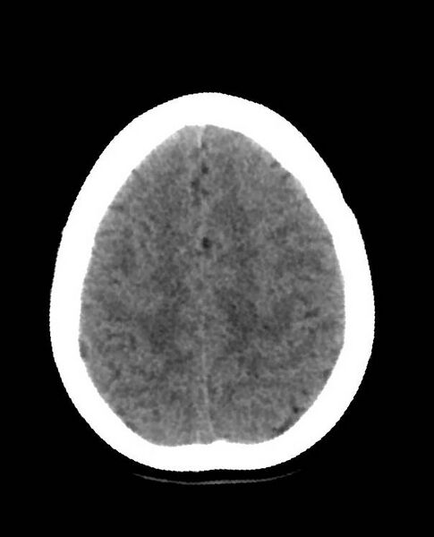 File:Cerebral edema due to severe hyponatremia (Radiopaedia 89826-106938 Axial non-contrast 82).jpg