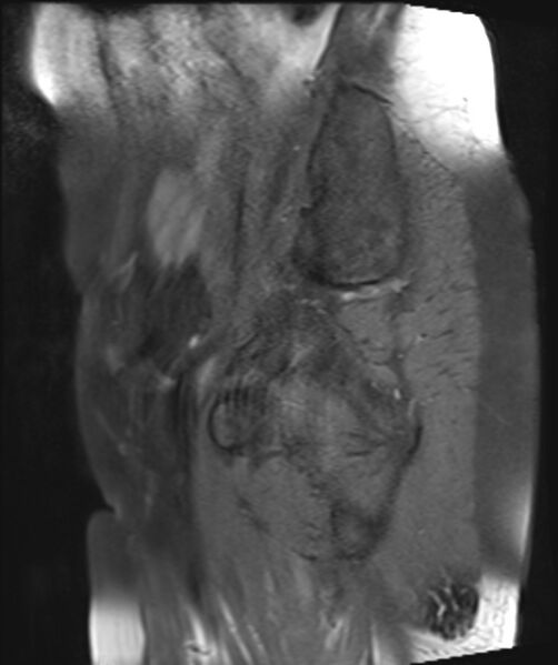 File:Cervical carcinoma (Radiopaedia 88312-104943 Sagittal T1 fat sat 25).jpg