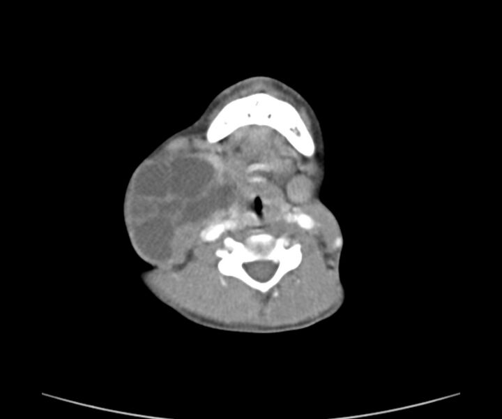 File:Cervical cystic lymphangioma (Radiopaedia 63655-72332 Axial + contrast 17).jpg