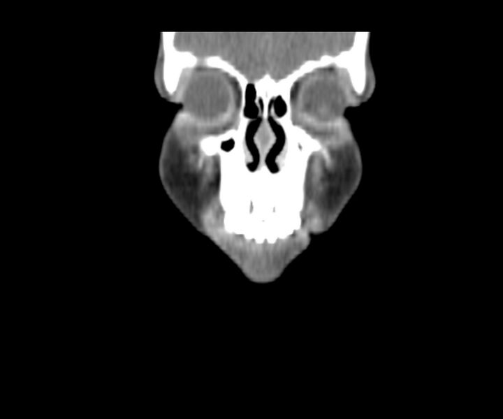 File:Cervical cystic lymphangioma (Radiopaedia 63655-72332 Coronal + contrast 6).jpg
