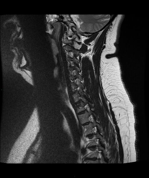 File:Cervical disc prolapse (Radiopaedia 80258-93598 Sagittal T2 4).jpg