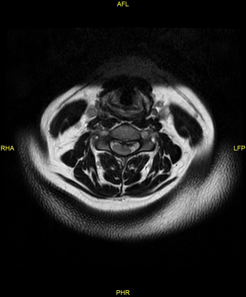 Cervical disc protrusion (Radiopaedia 87147-103415 Axial T2 15).jpg