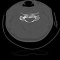 Cervical flexion teardrop fracture with cord hemorrhage (Radiopaedia 32497-33454 Axial bone window 41).jpg
