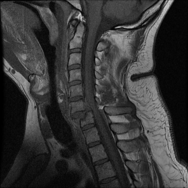 File:Cervical fracture and dislocation with locked facet (Radiopaedia 31837-32781 Sagittal T1 8).jpg