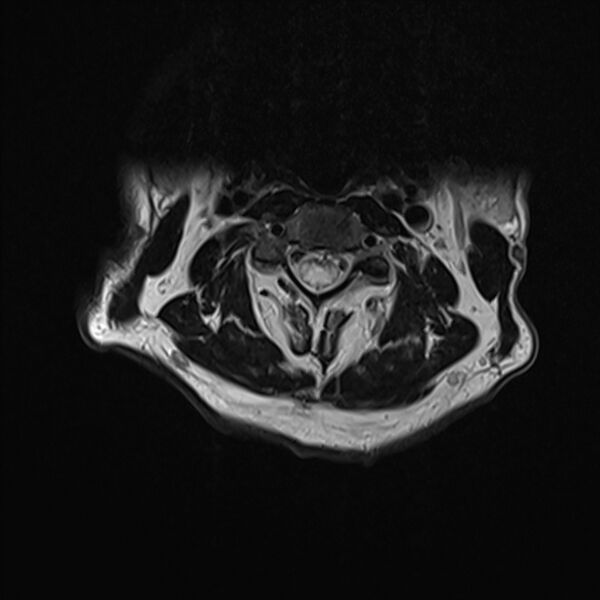 File:Cervical tumor-like myelopathy due to Type V dAVF (Radiopaedia 82461-96604 Axial T2 12).jpg