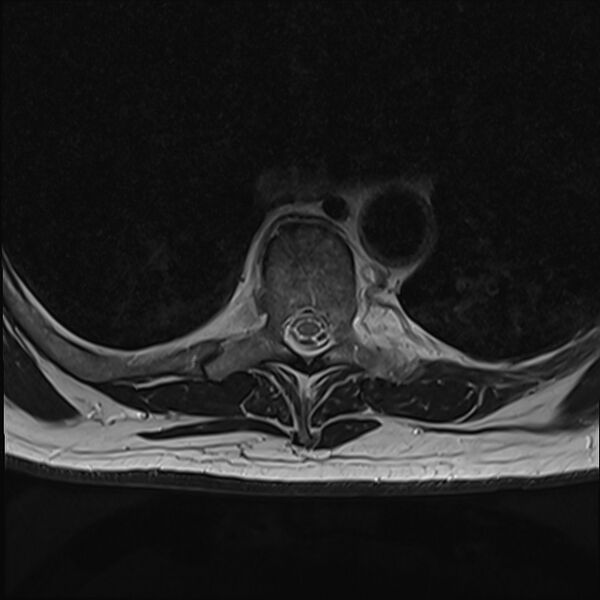 File:Cervical tumor-like myelopathy due to Type V dAVF (Radiopaedia 82461-96604 D 30).jpg