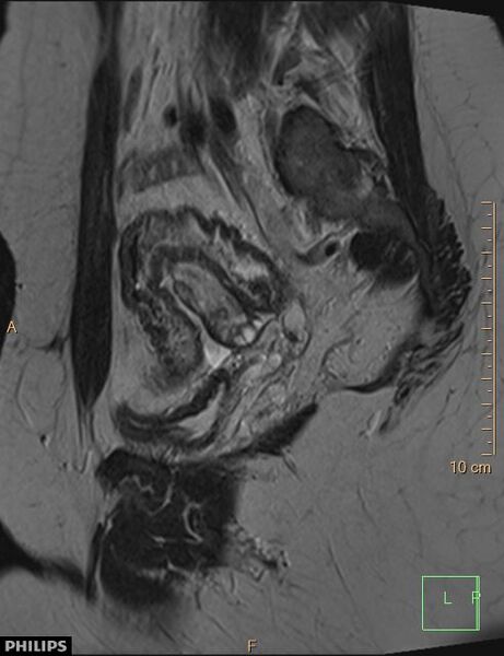 File:Cesarian scar endometriosis (Radiopaedia 68495-78066 Sagittal T2 8).jpg