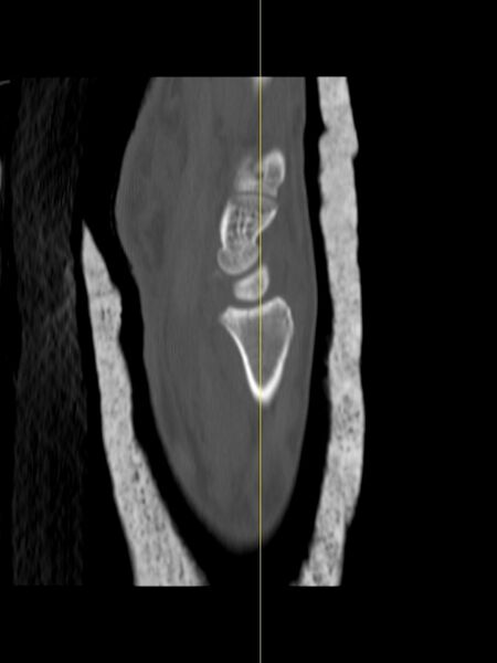 File:Chauffeur's (Hutchinson) fracture (Radiopaedia 58043-65079 Sagittal bone window 11).jpg