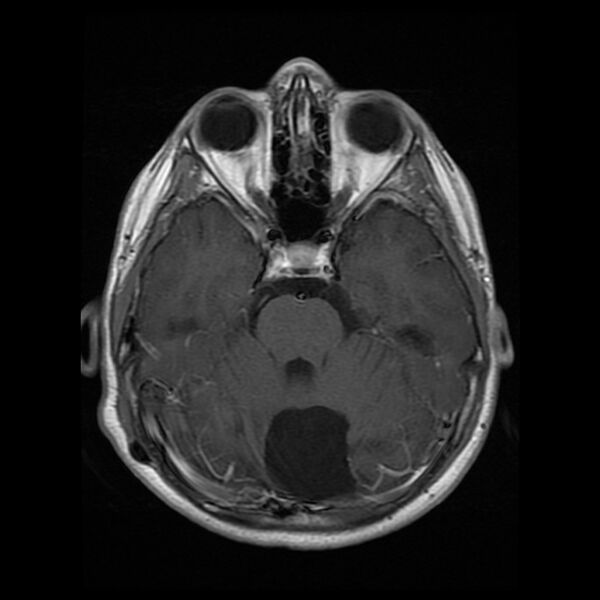 File:Chiasmatic-hypothalamic juvenile pilocytic astrocytoma (Radiopaedia 78533-91236 Axial T1 C+ 11).jpg