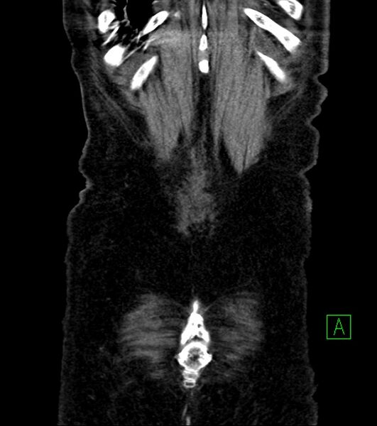 File:Cholangiocarcinoma with cerebral metastases (Radiopaedia 83519-98629 E 82).jpg