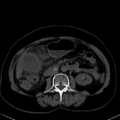 Cholecystitis - CT IVC obstructive choledocholitiasis (Radiopaedia 43966-47479 C 57).png