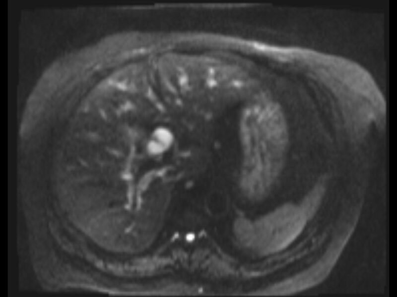 File:Choledocholithiasis causing intrahepatic biliary duct dilation (Radiopaedia 39908-42369 Axial T2 SPAIR 47).jpg