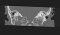 Cholesteatoma (Radiopaedia 10742-11203 Coronal bone window 18).jpg
