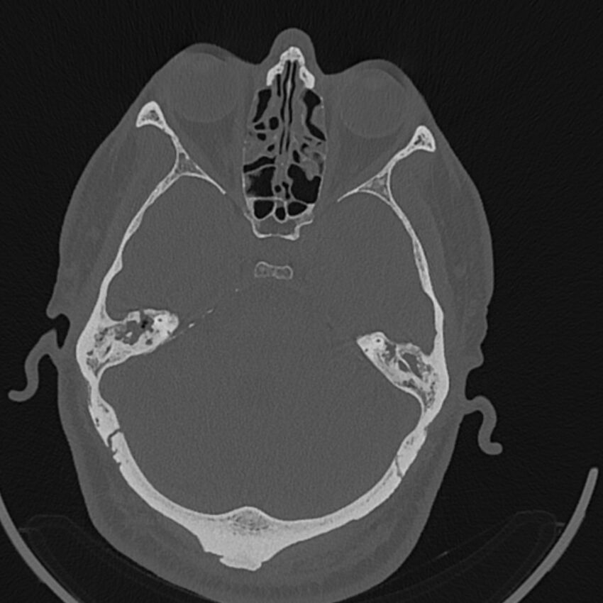 Cholesteatoma (Radiopaedia 68176-77673 Axial bone window 65).jpg