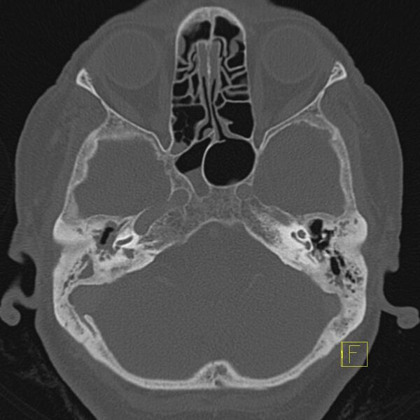 File:Cholesteatomatous chronic otitis (Radiopaedia 14993-14911 Axial bone window 16).JPEG
