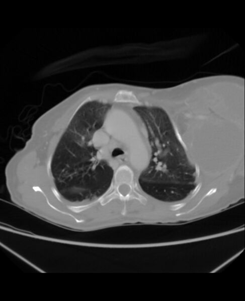 File:Chondrosarcoma (Radiopaedia 79427-92535 Axial lung window 17).jpg