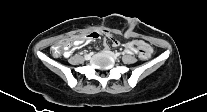 File:Choriocarcinoma liver metastases (Radiopaedia 74768-85766 A 142).jpg