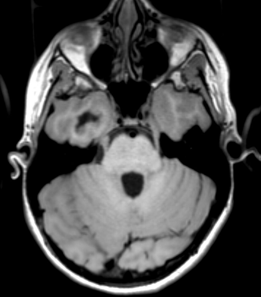 Choroid plexus carcinoma (Radiopaedia 91013-108553 Axial T1 58).jpg
