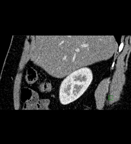 File:Chromophobe renal cell carcinoma (Radiopaedia 84286-99573 F 132).jpg