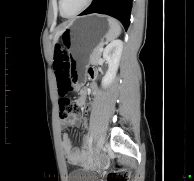 File:Chronic abscess due to "dropped" appendicoliths following appendectomy for perforated appendix (Radiopaedia 58805-66344 D 20).jpg