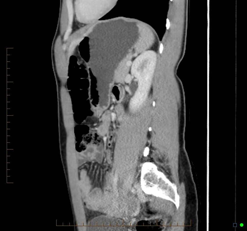 Chronic abscess due to "dropped" appendicoliths following appendectomy for perforated appendix (Radiopaedia 58805-66344 D 20).jpg
