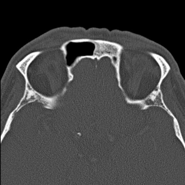File:Chronic maxillary sinusitis (Radiopaedia 27879-28116 Axial bone window 43).jpg