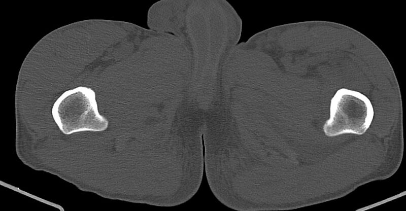 File:Chronic osteomyelitis (with sequestrum) (Radiopaedia 74813-85822 Axial non-contrast 60).jpg