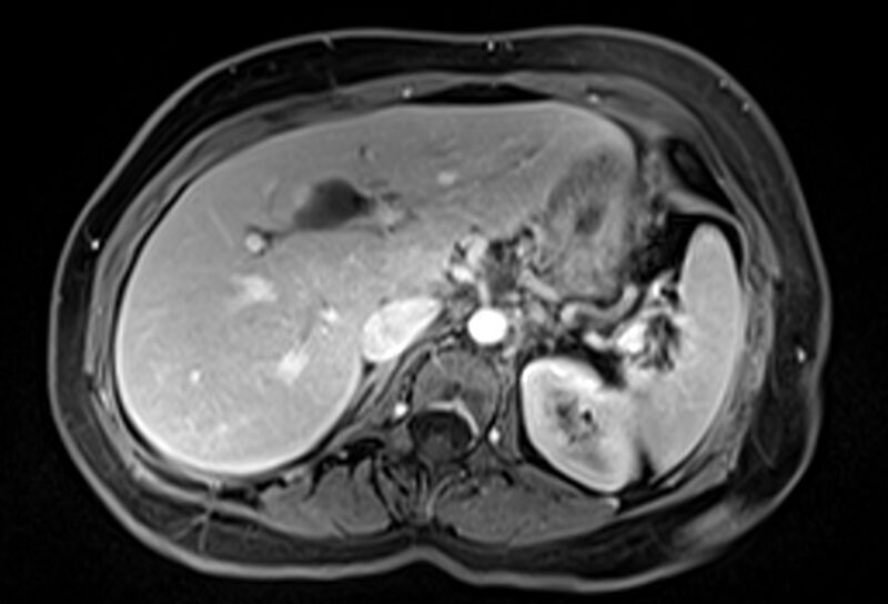 File:Chronic pancreatitis - pancreatic duct calculi (Radiopaedia 71818-82250 Axial T1 C+ fat sat 19).jpg
