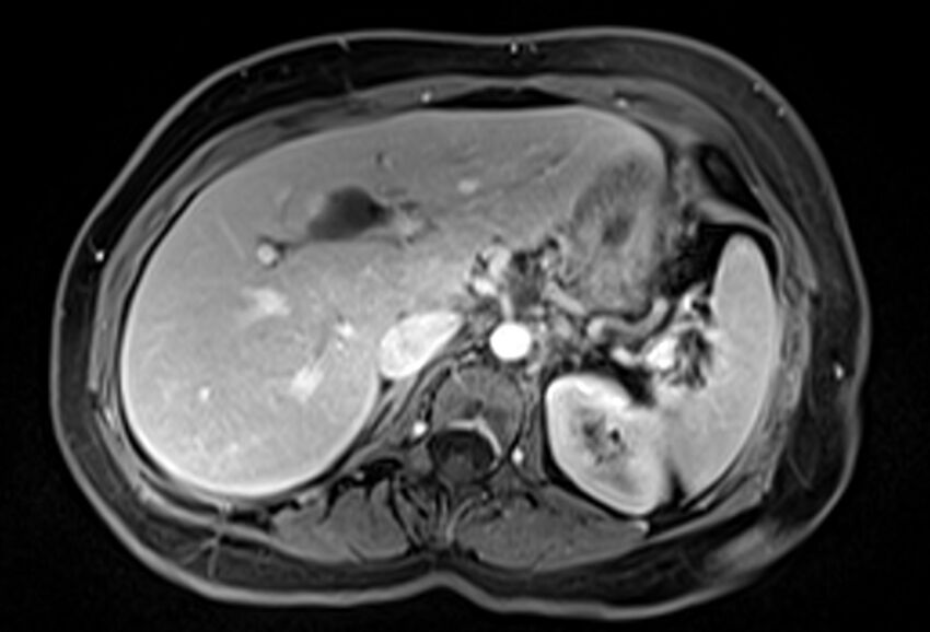 Chronic pancreatitis - pancreatic duct calculi (Radiopaedia 71818-82250 Axial T1 C+ fat sat 19).jpg