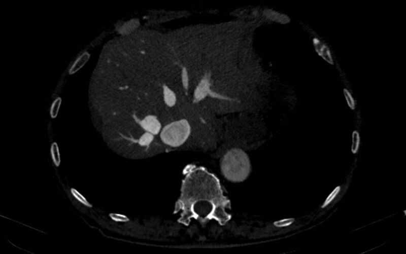File:Chronic pulmonary embolism (Radiopaedia 91241-108843 B 166).jpg