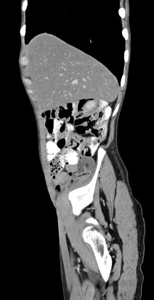 File:Chronic small bowel volvulus (Radiopaedia 75224-86322 C 120).jpg