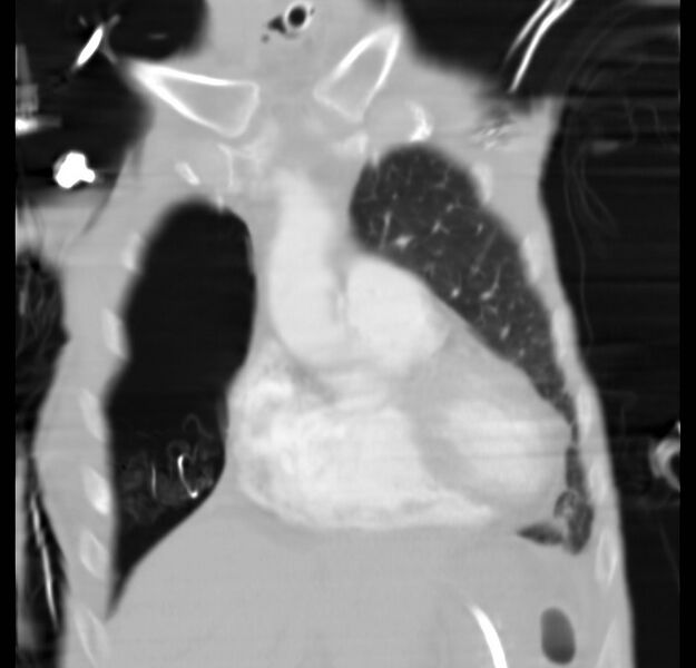 File:Clagett thoracotomy with bronchopleural fistula (Radiopaedia 29192-29587 Coronal lung window 24).jpg