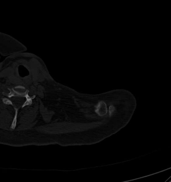 File:Clear cell chondrosarcoma - humerus (Radiopaedia 63104-71612 Axial bone window 6).jpg