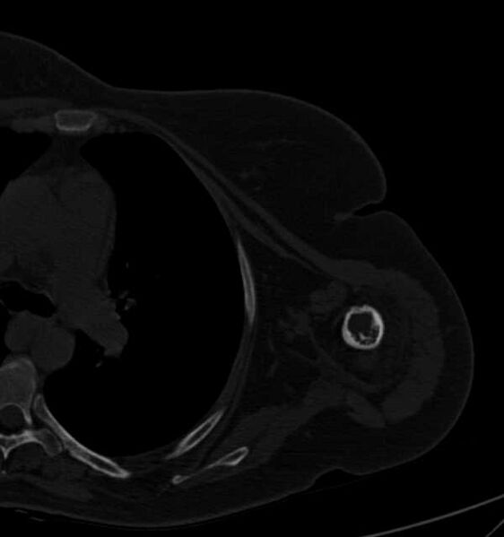File:Clear cell chondrosarcoma - humerus (Radiopaedia 63104-71612 Axial bone window 71).jpg