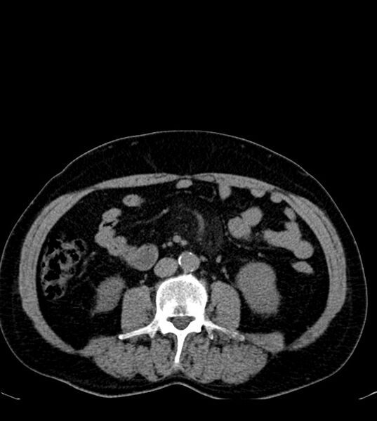 File:Clear cell renal cell carcinoma (Radiopaedia 85006-100539 Axial non-contrast 48).jpg