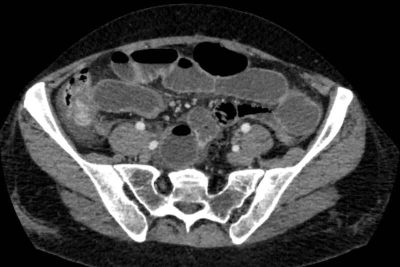 File:Closed loop small bowel obstruction (Radiopaedia 71211-81508 A 109).jpg
