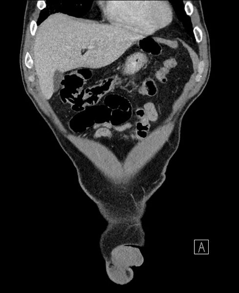 File:Closed loop small bowel obstruction - internal hernia (Radiopaedia 57806-64778 A 21).jpg