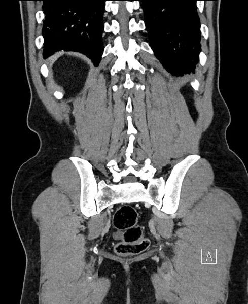 File:Closed loop small bowel obstruction - internal hernia (Radiopaedia 57806-64778 A 98).jpg