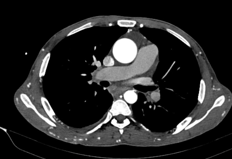 File:Coarctation of aorta with aortic valve stenosis (Radiopaedia 70463-80574 A 83).jpg