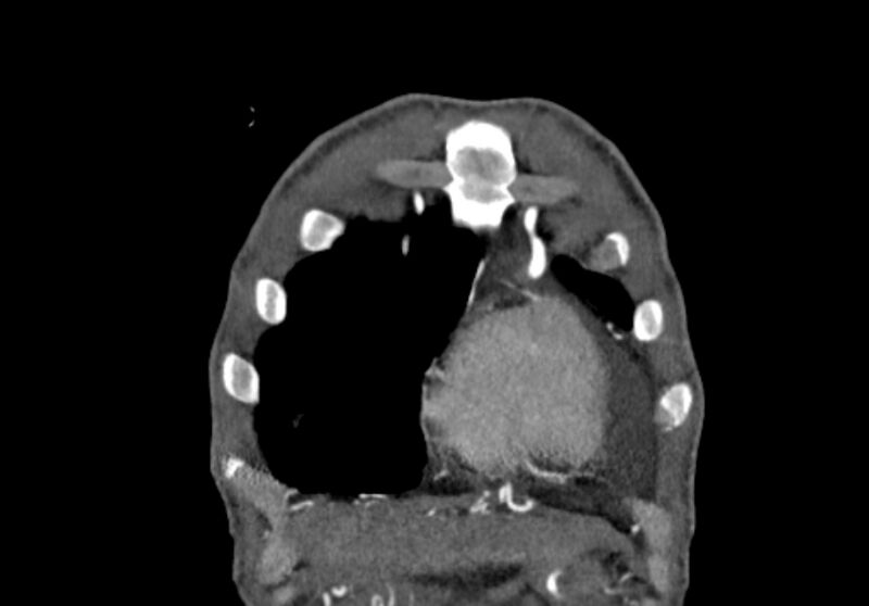 File:Coarctation of aorta with aortic valve stenosis (Radiopaedia 70463-80574 C 7).jpg