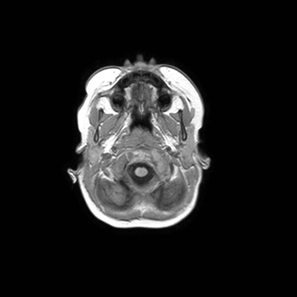 File:Cochlear nerve aplasia - unilateral (Radiopaedia 87910-104413 Axial T1 3).jpg