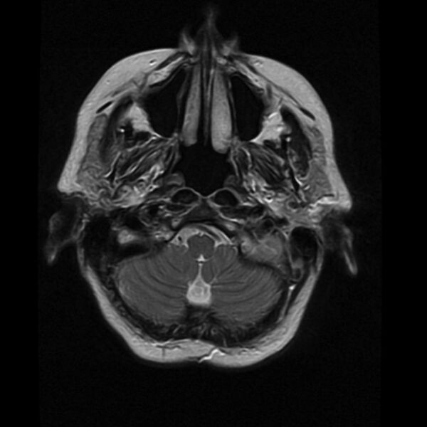 File:Colloid cyst with hydrocephalus (Radiopaedia 9373-10065 Axial T2 2).jpg