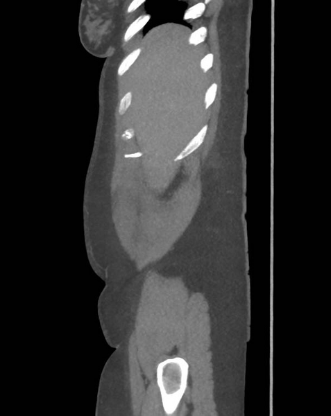 File:Colonic pseudo-obstruction (Radiopaedia 79752-92980 C 12).png
