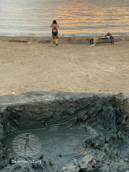 File:Dead Sea mud therapy (DermNet NZ dead-sea-mud).jpg