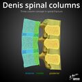 Denis three column concept in spinal fracture (Radiopaedia 32621).jpg